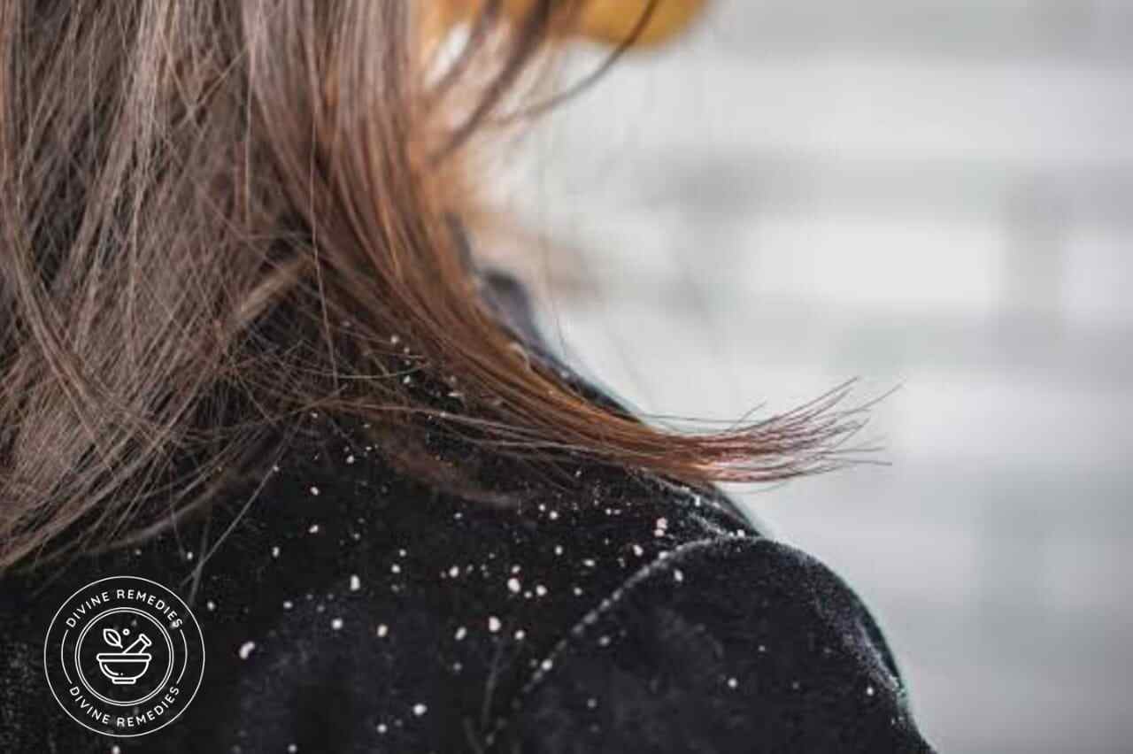 Treat Dandruff with simple and natural ingredients