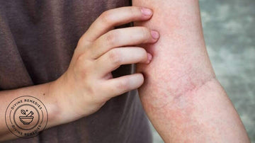 Control Rashes using coconut oil