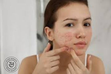 Honey for acne