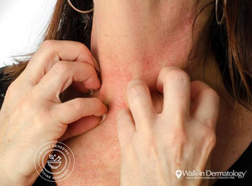 Quick Remedy for allergy